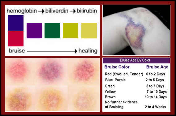 Bruise Stages